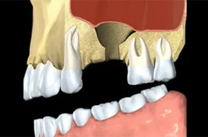 dental bone graft