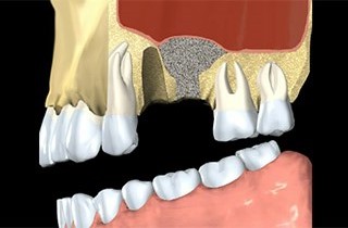 Dental bone loss in upper jaw dental bone loss