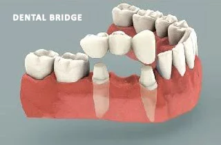 dental bridge or dental implant