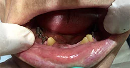 dental implants reviews