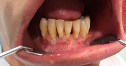 Dental implants abroad reviews