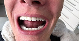 Hungary dental implants