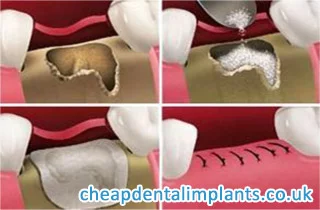 dental bone graft material