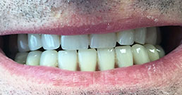 Dental implants before and after Dental implants before and after