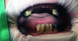 Teeth implants before and after Teeth implants before and after