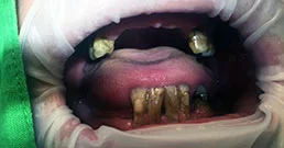 Teeth implants before and after