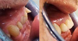 Crown teeth before and after crown teeth before and after