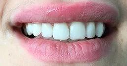 Dental veneers before and after