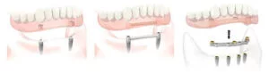 Implant support dentures