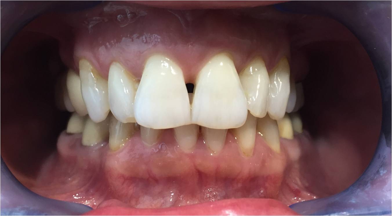 teeth veneers before and after