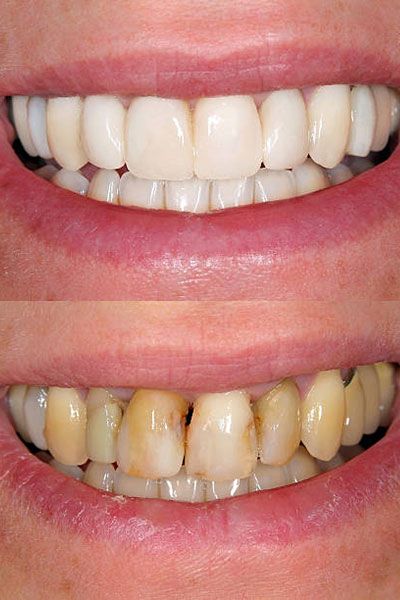 celebrity-veneers - CheapDentalImplants