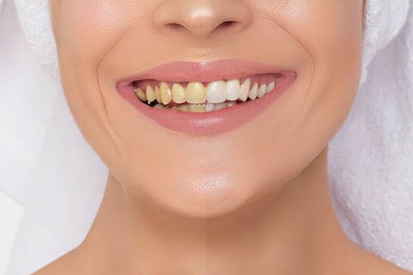 Stained teeth, teeth discoloration - BestDentalImplantsOnline