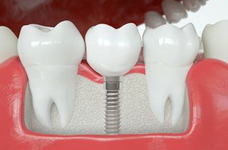 dental--implant-abroad