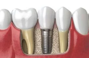 dental-implants-hungary