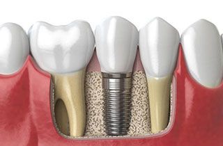 dental-implants-hungary