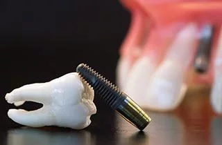 immediate-loading-of-dental-implants